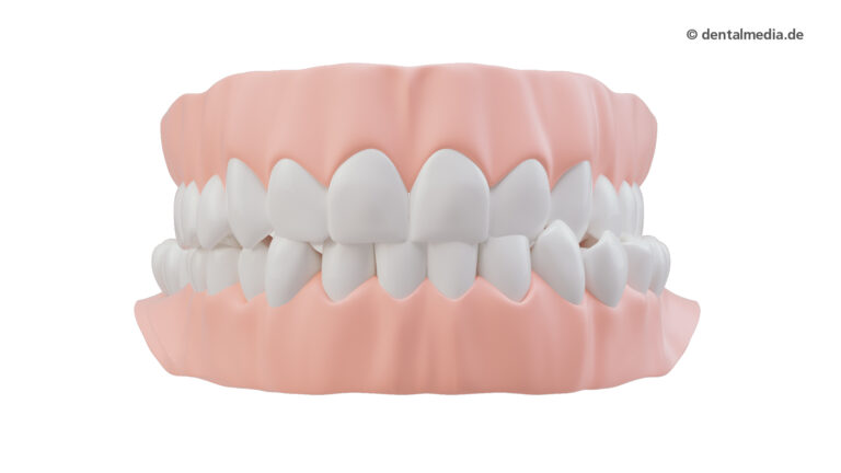 Zahnfehlstellung Kreuzbiss einseitig